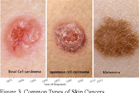 Appearance Of Skin Cancer Types