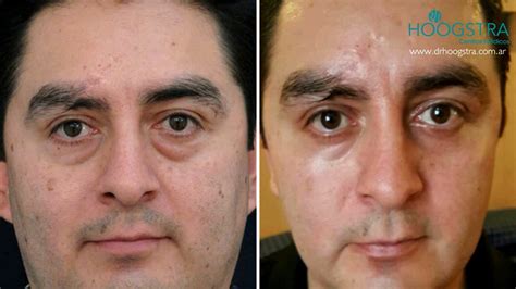 Blefaroplastia Antes E Depois Homem - [: es] Blefaroplastia antes e depois - fotos, opiniões e resultados ...