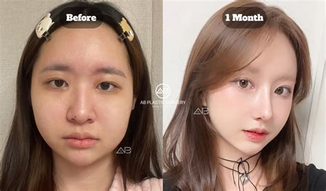 finding  ideal eye shape korean eye surgery   trends