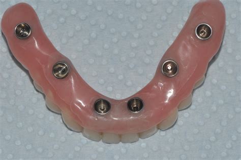 Implant Supported Bridge/Denture/All-on-4® - Applecross House Dentist