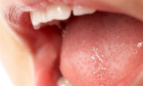 Home Remedies for Tongue Sores | The Best 6 Remedies