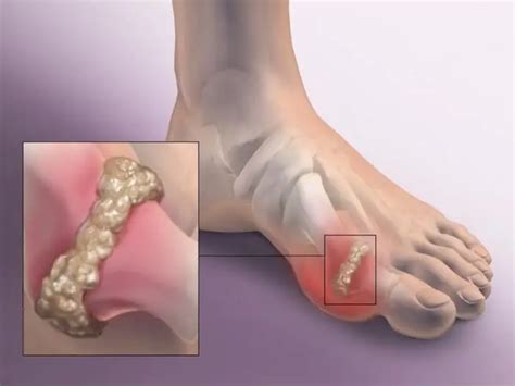 gout drug treatment gout attack diseases  conditions