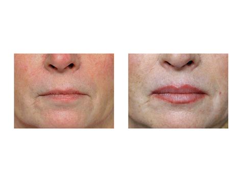 Consent for Plastic Surgery: Lip Lifts, Lip Advancements and Corner of