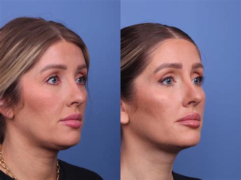 submental liposuction    pictures case  scottsdale