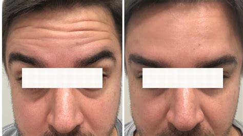 Botox Testa Antes E Depois - Botox na testa: como é feito, antes e depois e preço!
