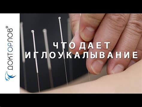 Что дает иглоукалывание? - YouTube