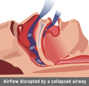 sleep-apnea-diagram | SleepMD Anti Snoring Mouthpiece