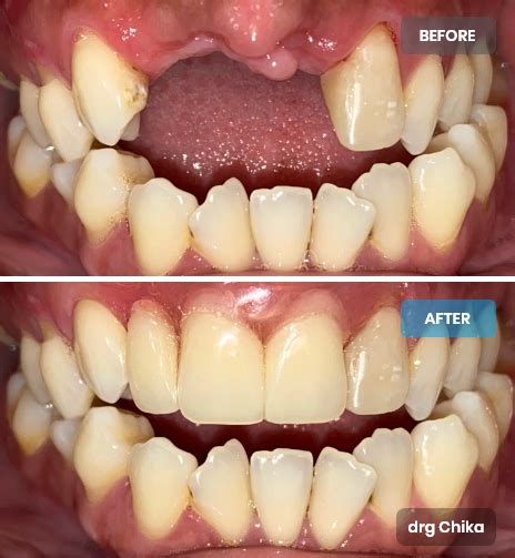 pemasangan gigi tiruan griya denta