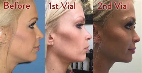 kybella   eyelid kybella  atlanta double chin reduction