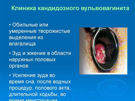 Воспалительные заболевания женских половых органов - презентация онлайн