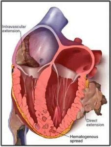 Knowing about heart cancer in a more detailed manner