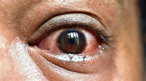 ‘Red eye disease’ hits coastal Kenya | Zambia Monitor