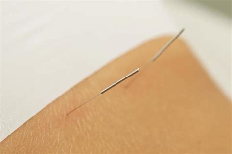 Acupuncture Needles Stock Photos, Images and Backgrounds for Free Download