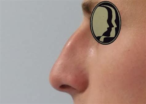 Nasal Reconstruction - Dr Hamilton