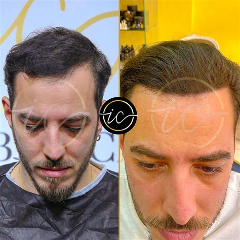 turkish hair transplant cost 9