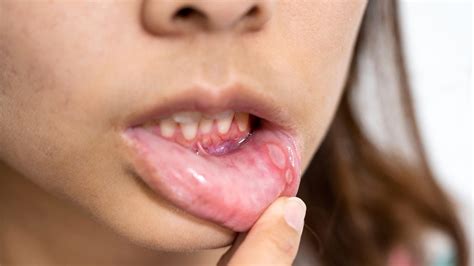 Cuts in the Mouth: How to Treat and Prevent Oral Wounds