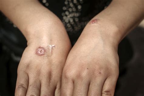 CDC says skin-disfiguring parasite may be endemic in Texas, present in other states