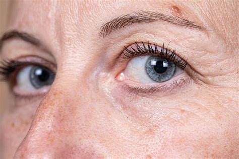 RelabotulinumtoxinA Significantly Improved Glabellar and Lateral ...