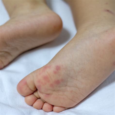 Borkenflechte (Impetigo contagiosa): Ursachen & Behandlung