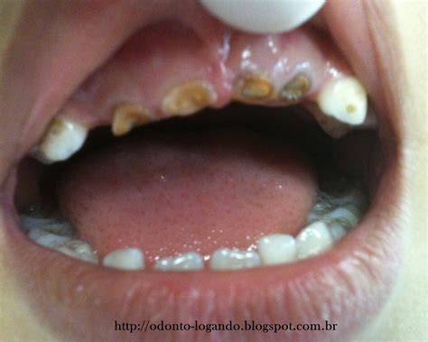 Meus Dentes Estão Quebrando - Odontologando: Os dentes de leite do meu filho estão quebrando. Por que?