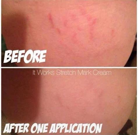 After ONE application of the stretch mark cream and her stretch marks ...