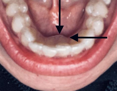 day  tray  gap  bottom front teeth normal  tracking issue