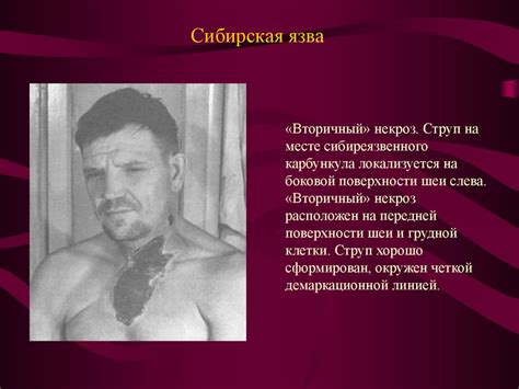 Сибирская язва - презентация онлайн