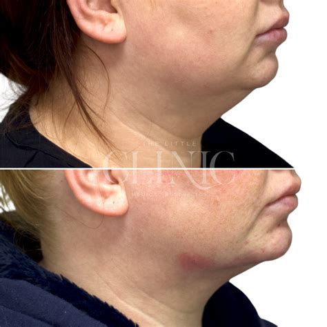 fat dissolving tlc medical aesthetics