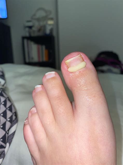 Before vs after medical foot care trim and onyfix application! I’m so