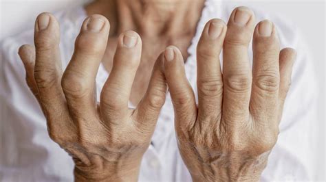 A Artrite Reumatoide é Uma Doença Inflamatória Crônica Que Geralmente