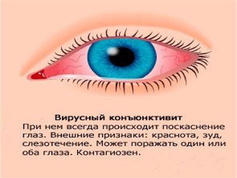 Конъюнктивиты - презентация онлайн
