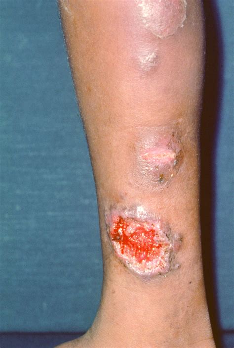 Pyoderma Gangrenosum - Dermatologic Disorders - MSD Manual Professional