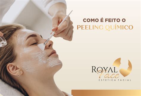 O Que É O Peeling Quimico - Como é feito o peeling químico - Royal Face
