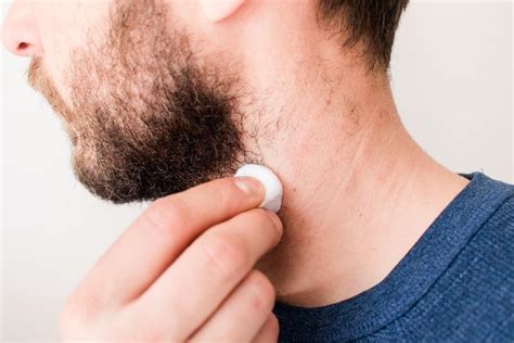 how to soothe ingrown hairs