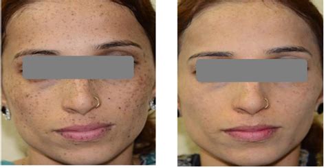 hyperpigmentation pih treatment  leeds  leeds clinic