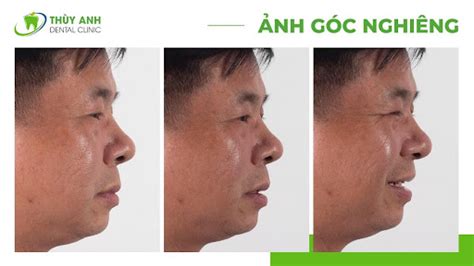 mon rang tram trong phuc hoi nhu  nao hieu qua nhakhoathuyanh