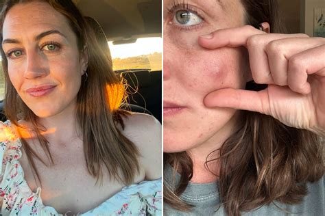 Popping Pimples On Back