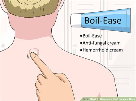 4 Ways to Remove a Cyst on Your Back - wikiHow