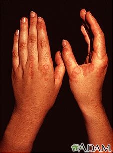 Mycoplasma Pneumonia - UF Health