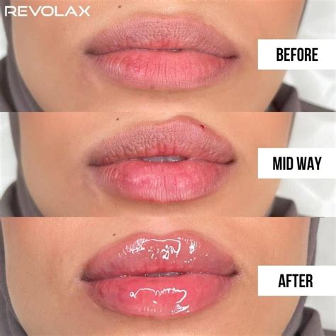 lip filler      results  daily glimmer