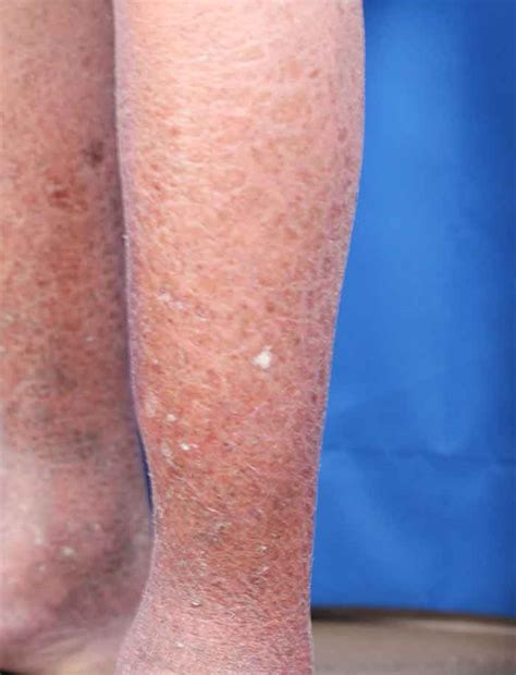 Brown Scaly Spots On Skin - vrogue.co