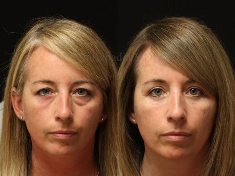 Before and five months after upper and lower blepharoplasty surgery