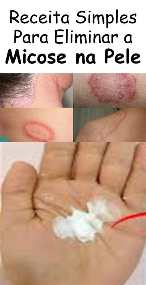 Como Curar Micose De Pele - Como Tratar Micose De Pele? : Micose de Pele (Tinea corporis): sintomas ...