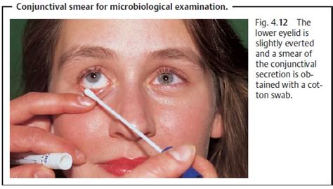 General Notes on the Causes, Symptoms, and Diagnosis of Conjunctivitis