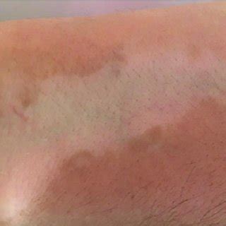 Depigmented macules in vitiligo. | Download Scientific Diagram