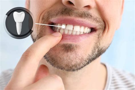 Why Choose Dental Implants? The Superior Tooth Replacement Solution at