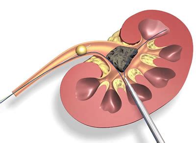 Kidney stone infection and surgery