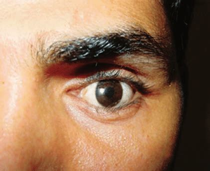 superior sulcus deformity  scientific diagram