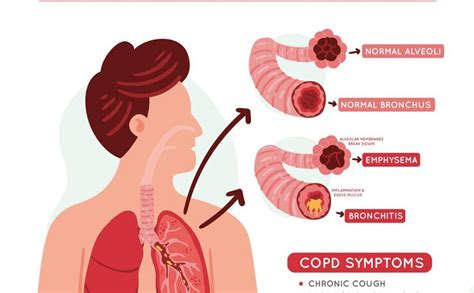 Affordable COPD Symptoms In Houston 77099 - Pioneer Research Solutions