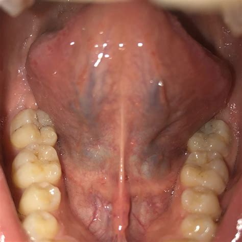 Moin bin der Thomas und meine Frage ist warum meine untere Zunge so